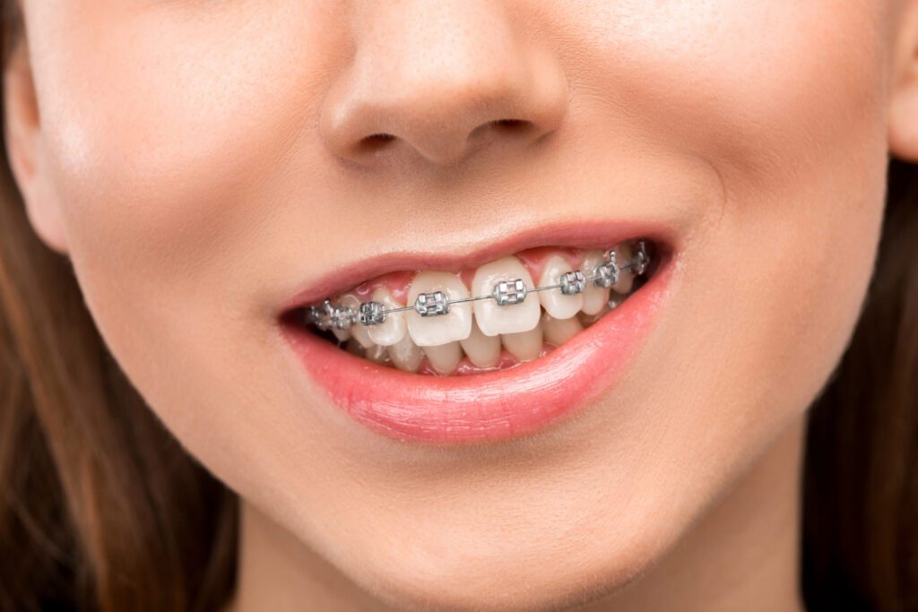 diş teli-bizdentalklinik
