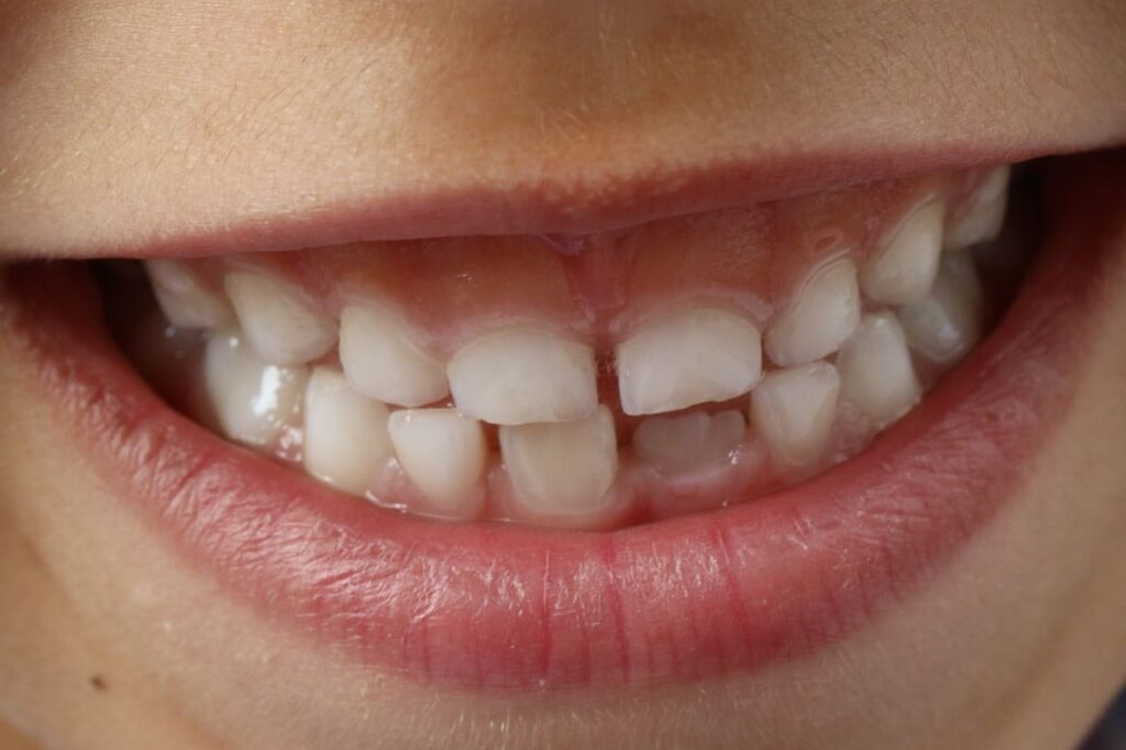 ayrık diş-bizdentalklinik